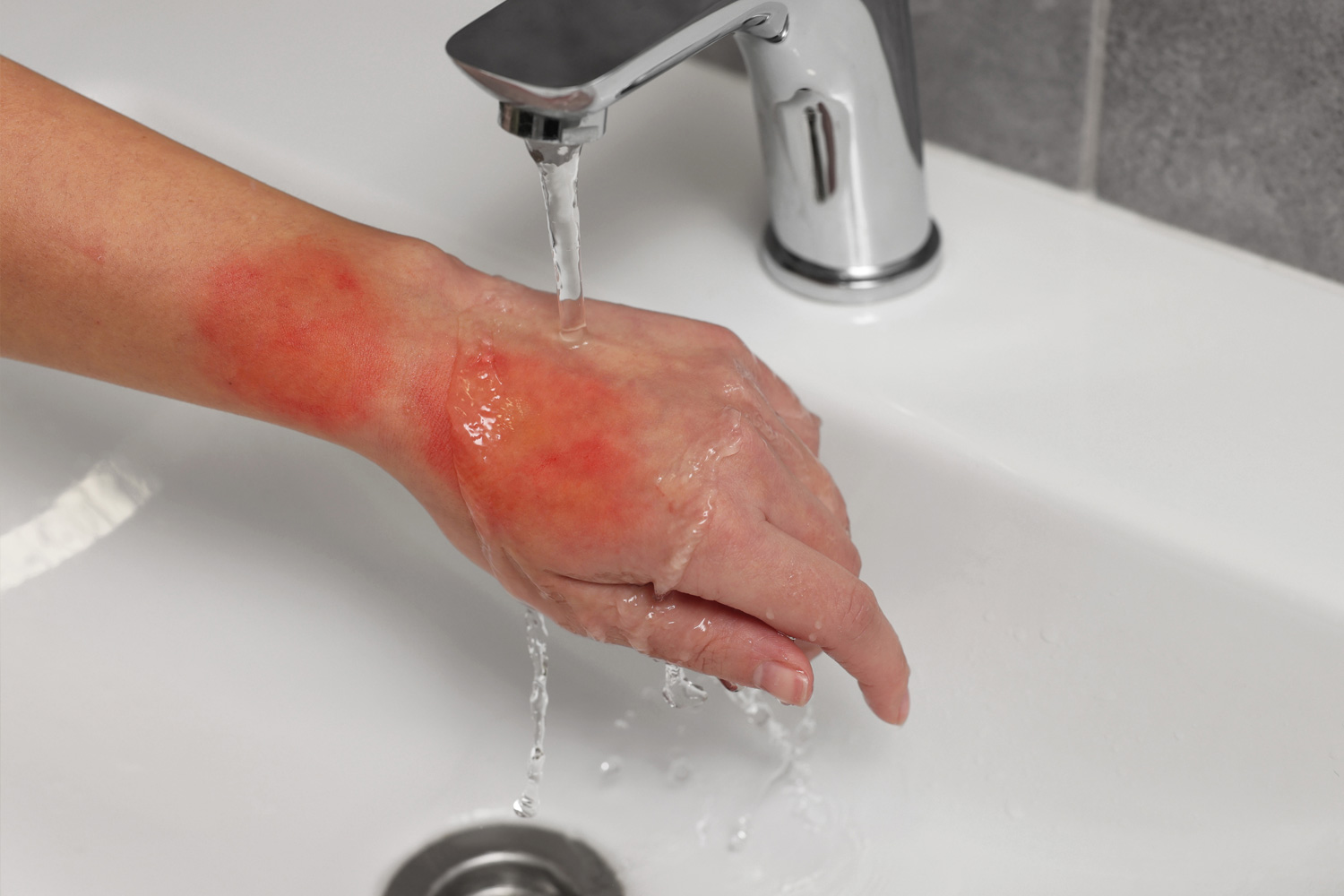 Burn first aid
